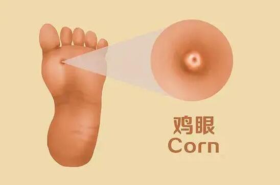 跖疣和鸡眼的区别